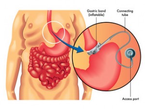 COS’E’ LA CHIRURGIA LAPAROSCOPIA